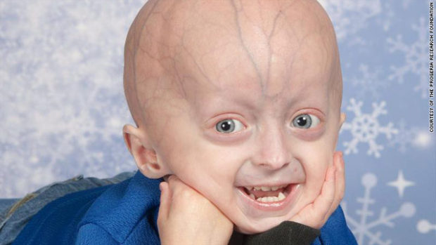 t1larg-progeria